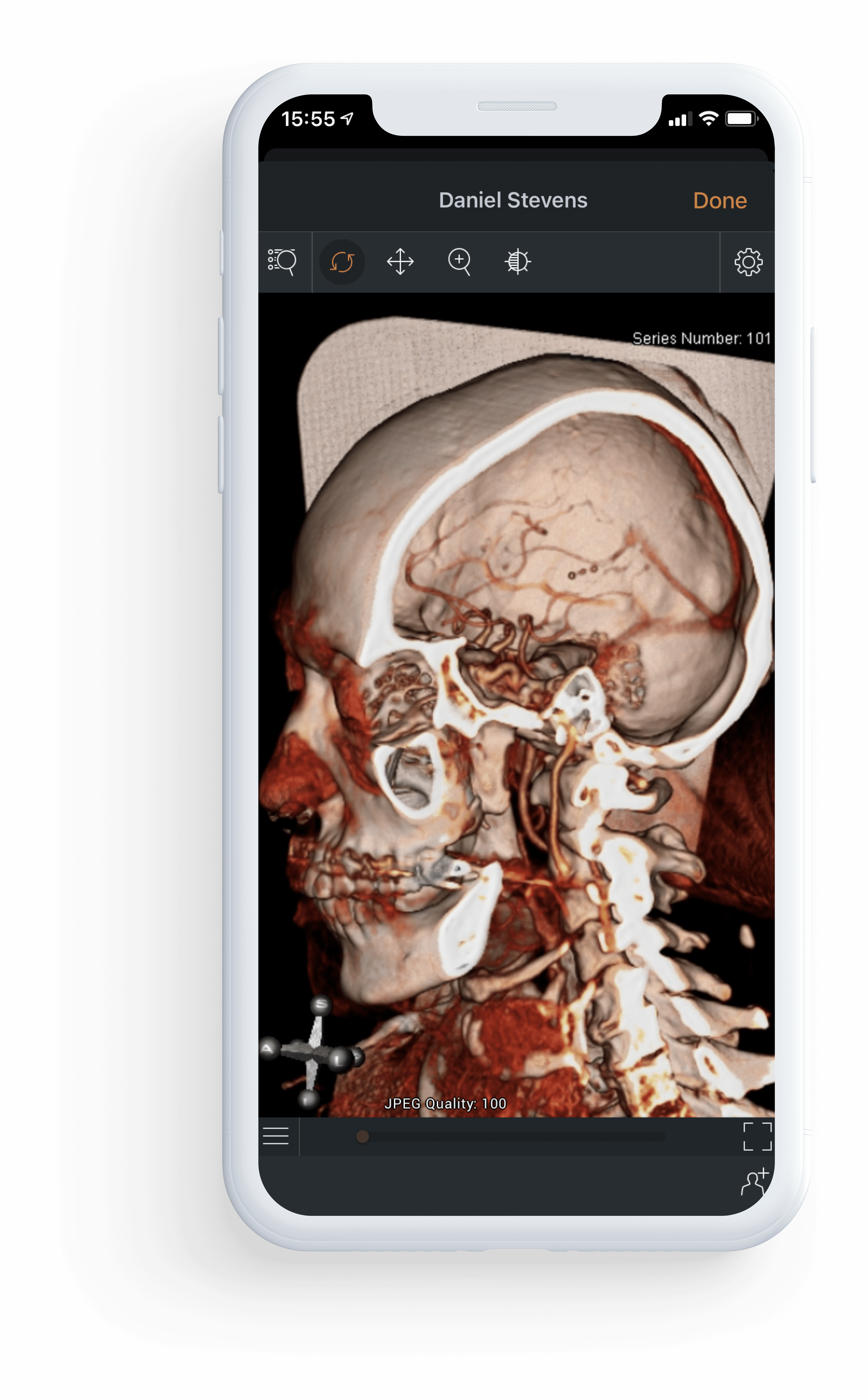 3D visualization of a patients head in the StrokeViewer mobile app
