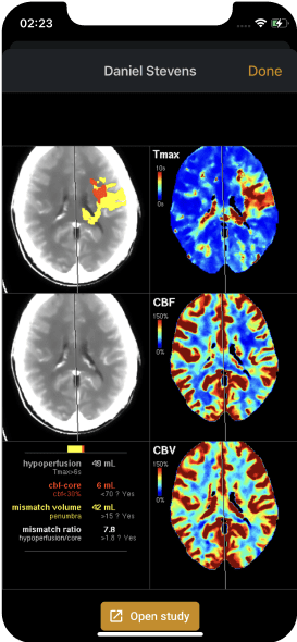 color-coded maps on CT perfusion images