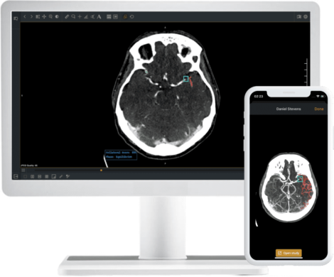 Collateral assessment with StrokeViewer