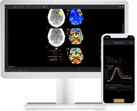 Automated perfusion analysis with StrokeViewer