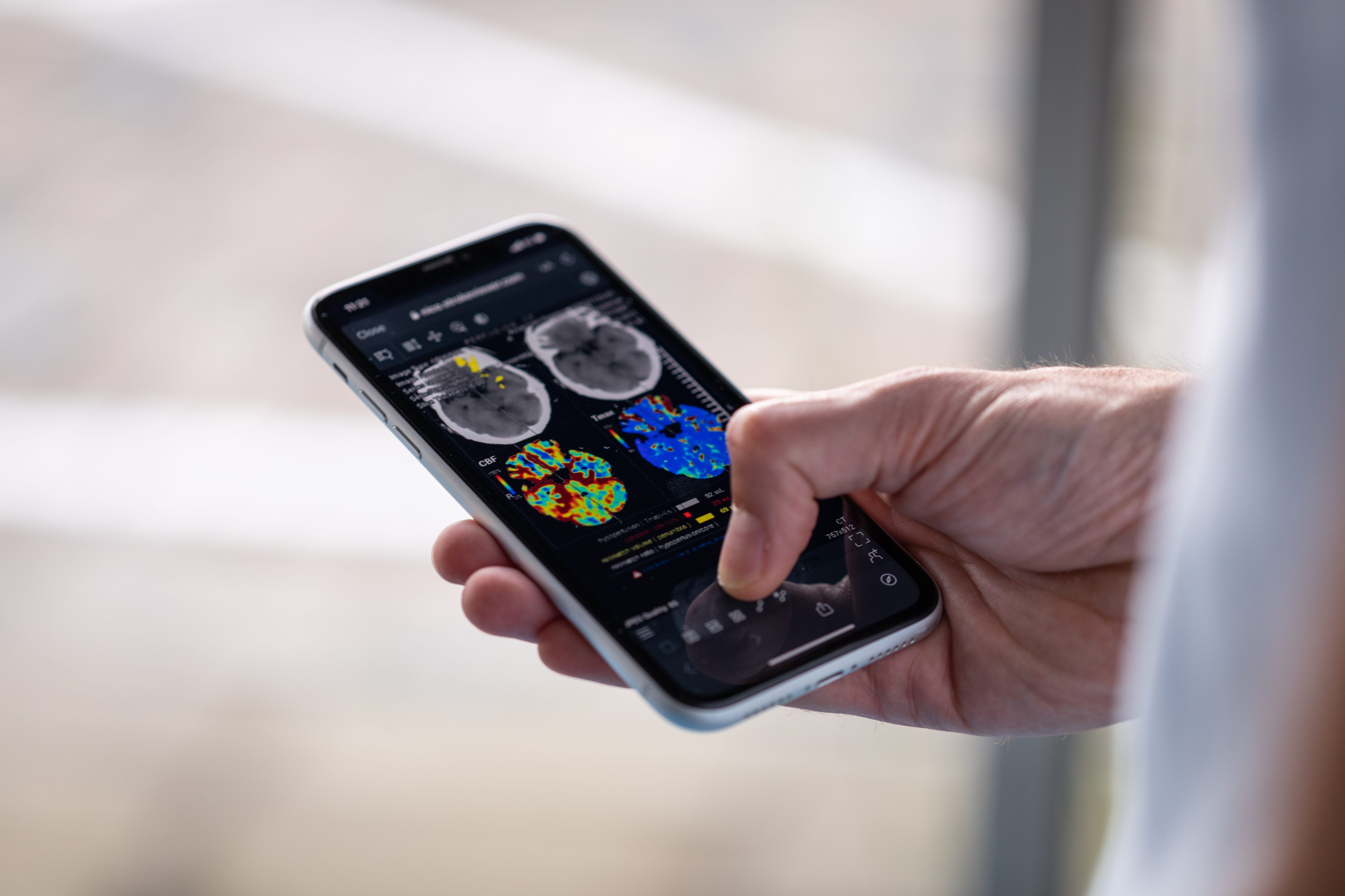 Nicolab Attains Significant Milestone in Stroke Care Advancement with U.S. FDA Clearance for CT Perfusion Algorithm in StrokeViewer