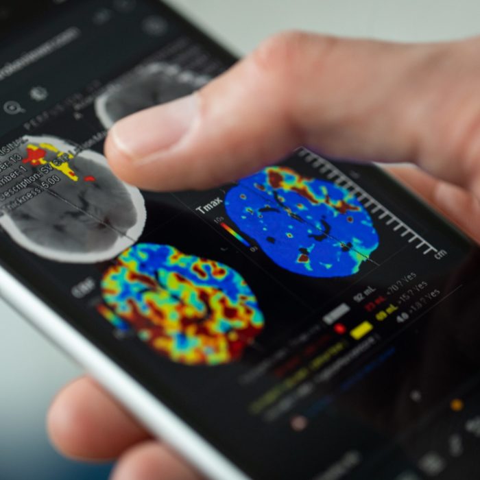 How cloud-based AI solutions are transforming stroke care