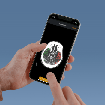 EVT for late-window ischemic stroke patients: the importance of a good collateral flow